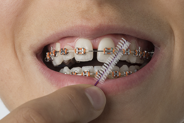 llustration d’un suivi orthodontique montrant l’ajustement d’appareils dentaires et la progression des dents.